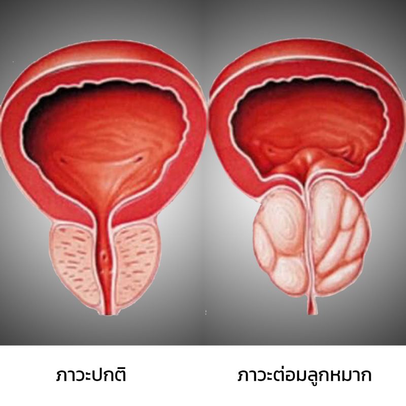 สาเหตุของ อาการต่อมลูกหมากอักเสบ มีอะไรบ้าง ?