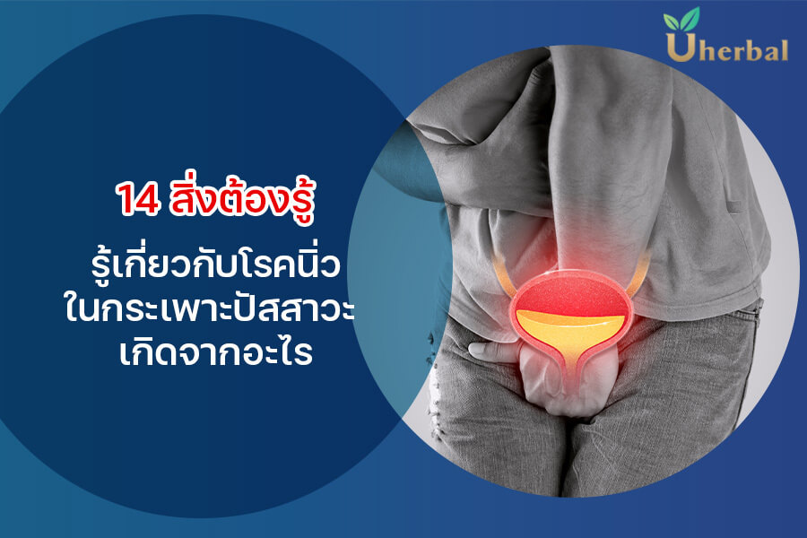 14 สิ่งต้องรู้เกี่ยวกับโรคนิ่วในกระเพาะปัสสาวะ เกิดจากอะไร? อาการ การป้องกัน